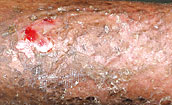 Results of epidermal graft 