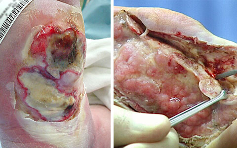 Complete Excision of Non-Viable Tissue