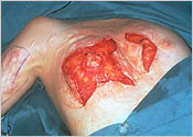Release that was achieved following a circumareolar incision  