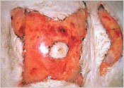 Appearance of the INTEGRA<sup></sup> two week post surgery