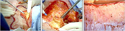 Excision of devitalized tissue