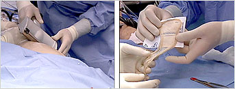 Technique of harvesting a thin epidermal graft