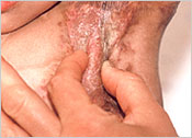 Neodermis elastic, functioning as normal papilary dermis 