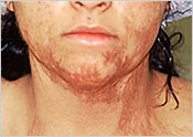Contracted scar lower chin