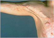 Residue scarring at the top of the right upper arm.